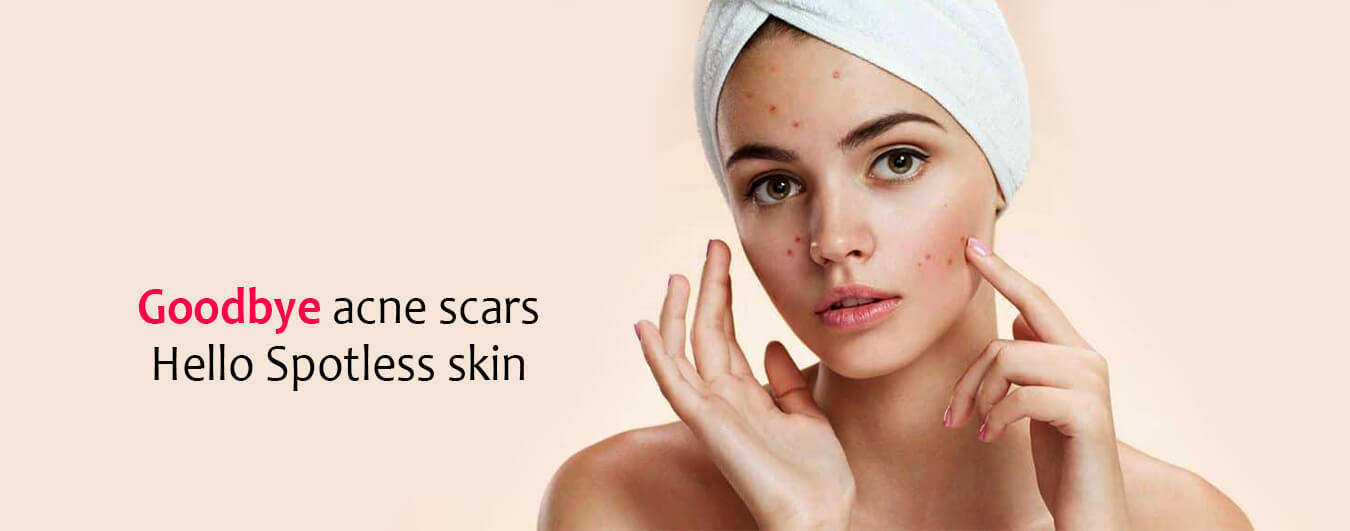 Acne Scar Treatment